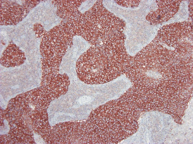 Figure 3. Immunohistochemistry of MUB1319P on formalin fixed, paraffin embedded tissue section of human breast carcinoma. Dilution 1:1000.